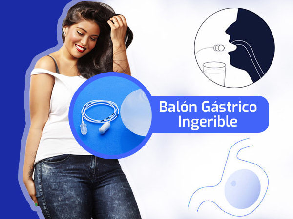 balon-gastrico-programa-ecuador