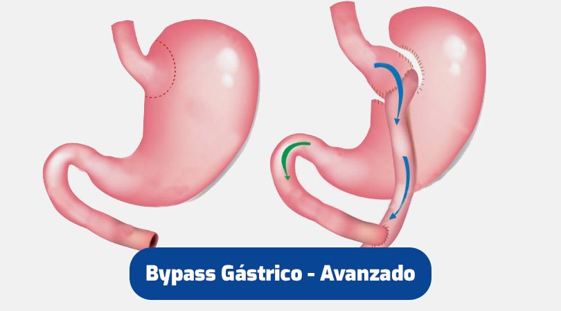 bypass-gastrico-avanzado