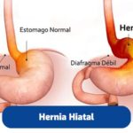 cirugia-hernia-hiatal-quito