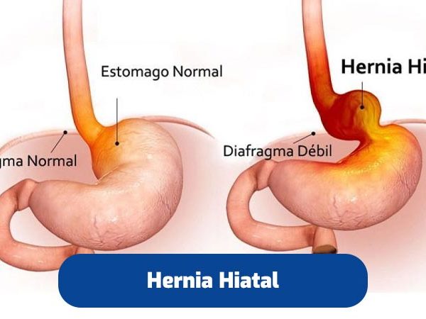 cirugia-hernia-hiatal-quito